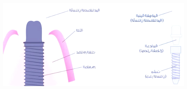 مراحل زراعة الأسنان