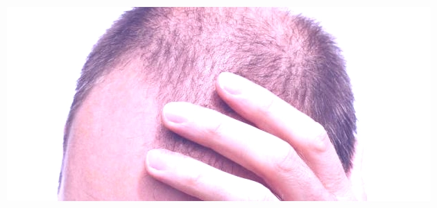 هل زراعة الشعر لها أضرار